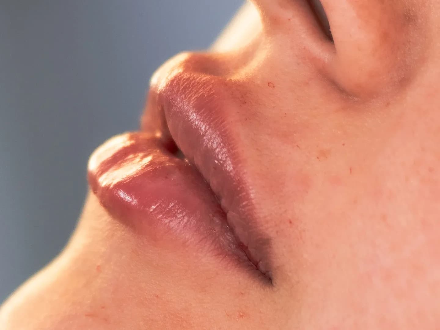 Relleno Labial - Antes